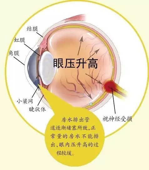 青光眼高危人群.